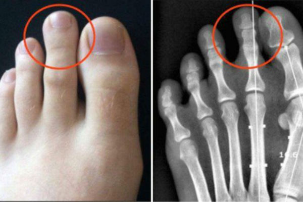 EVO ZAŠTO SAMO 14% STANOVNIŠTVA IMA DUŽI DRUGI PRST: Gledaćete ih drugim očima!