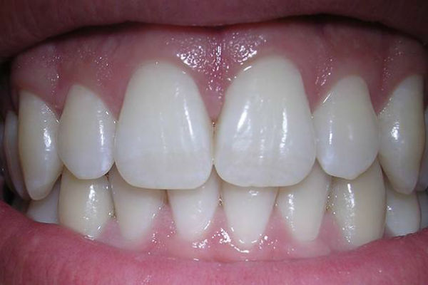 SVAKI TREĆI ČOVJEK ŠKRIPI ZUBIMA U SNU: Evo šta sve može biti UZROK problema