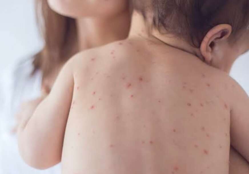 Koji su simptomi i moguće komplikacije: Ovo treba da znate o varičelama i morbilama