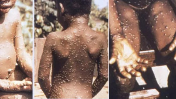 Potvrđen slučaj majmunskih boginja u Velikoj Britaniji