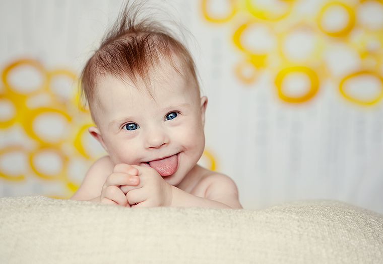 Sve više abortusa zbog Daunovog sindroma