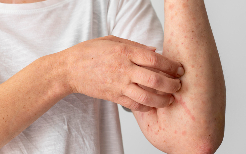  Više od 4.000 oboljelih od ospica u Sarajevu, vakcina jedini spas?