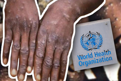  SZO procjenjuje proglašavanje vanredne situacije zbog majmunskih boginja