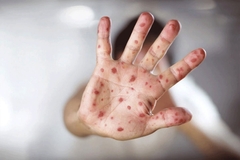 U Beogradu prijavljena epidemija malih boginja