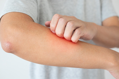Šta je psorijaza, gdje se javlja i kako se liječi