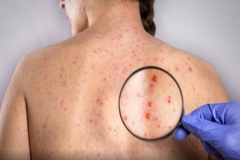 Panika u Evropi: Širi se rijetka infekcija majmunskih boginja