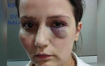 Za danas najavljeni protesti u Jablanici zbog radnice koju je pretukao vlasnik hotela