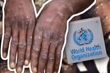  SZO procjenjuje proglašavanje vanredne situacije zbog majmunskih boginja