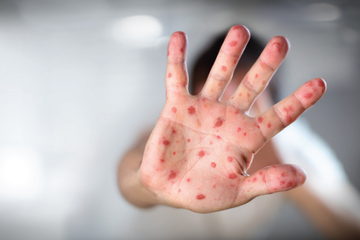 U Kantonu Sarajevo proglašena epidemija morbila