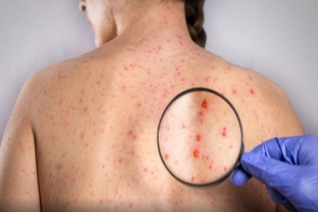 Panika u Evropi: Širi se rijetka infekcija majmunskih boginja