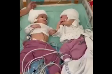 Vidjele se prvi put u životu: Uspješno razdvojene sijamske bliznakinje koje su rođene spojenih glava (FOTO, VIDEO)